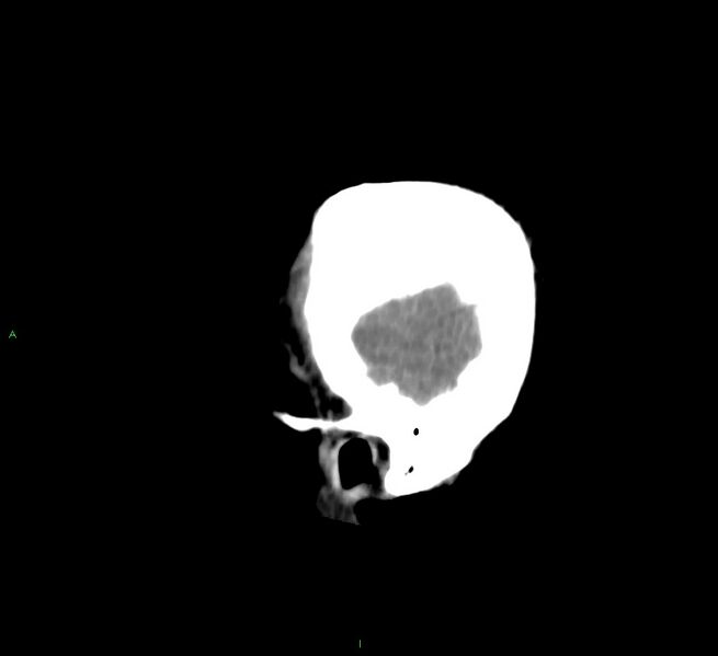 File:Cerebral amyloid angiopathy-associated lobar intracerebral hemorrhage (Radiopaedia 58756-65977 C 7).jpg