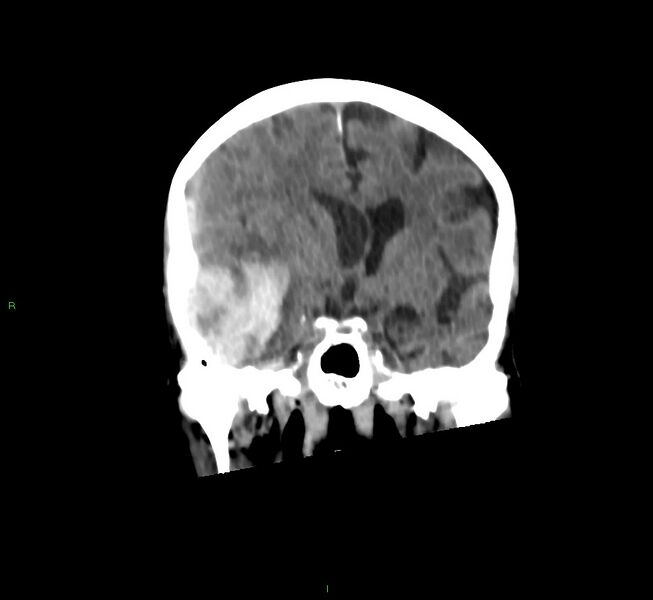 File:Cerebral amyloid angiopathy-associated lobar intracerebral hemorrhage (Radiopaedia 58758-65980 Coronal non-contrast 38).jpg