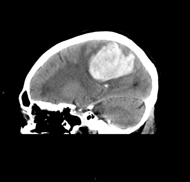 File:Cerebral amyloid angiopathy-associated lobar intracerebral hemorrhage (Radiopaedia 59356-66716 C 22).jpg