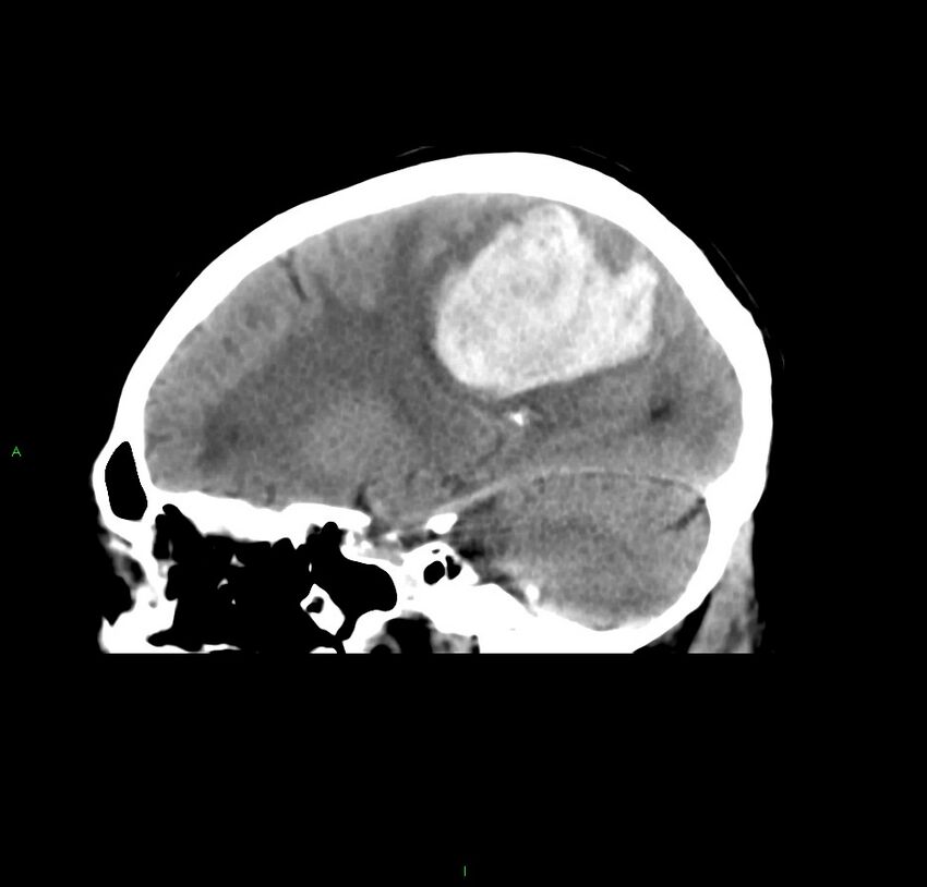 Cerebral amyloid angiopathy-associated lobar intracerebral hemorrhage (Radiopaedia 59356-66716 C 22).jpg