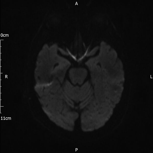 File:Cerebral amyloid angiopathy related inflammation (Radiopaedia 72772-83415 Axial DWI 55).jpg