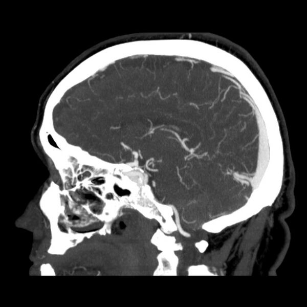 File:Cerebral arteriovenous malformation (Radiopaedia 43729-47189 D 21).jpg