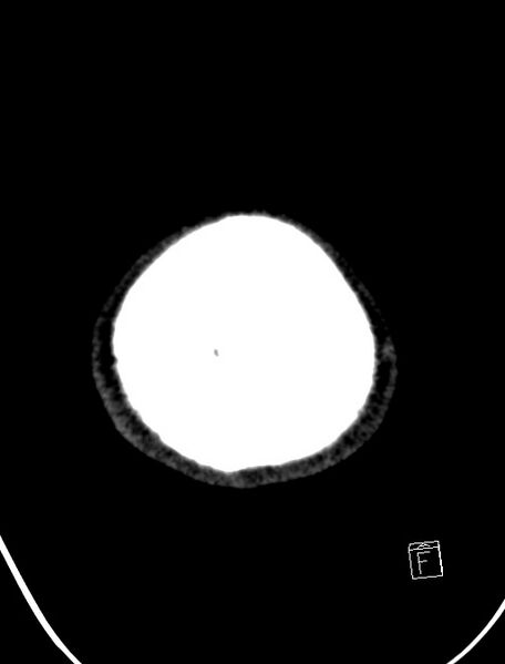 File:Cerebral arteriovenous malformation (Radiopaedia 78188-90745 Axial non-contrast 25).jpg