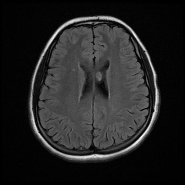 File:Cerebral cavernous malformation (Radiopaedia 44301-47942 Axial FLAIR 14).jpg