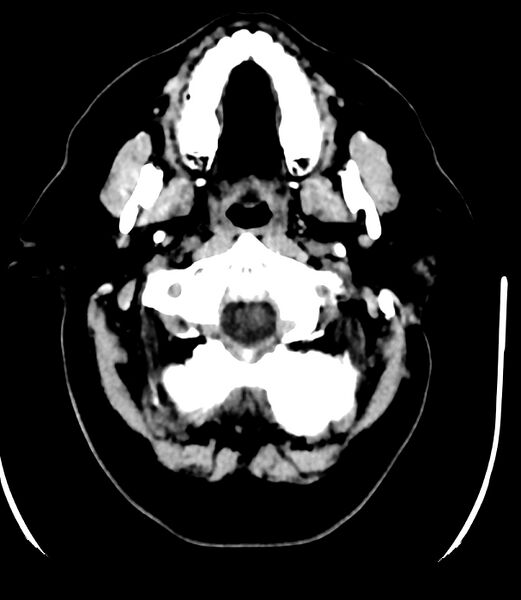 File:Cerebral dural venous sinus thrombosis (Radiopaedia 86514-102575 Axial non-contrast 3).jpg