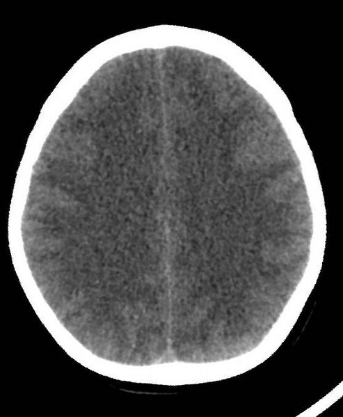 File:Cerebral edema due to severe hyponatremia (Radiopaedia 89826-106937 Axial non-contrast 60).jpg