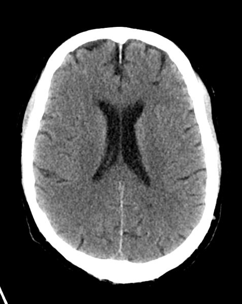 File:Cerebral embolic infarcts (embolic shower) (Radiopaedia 57395-64341 Axial non-contrast 19).png