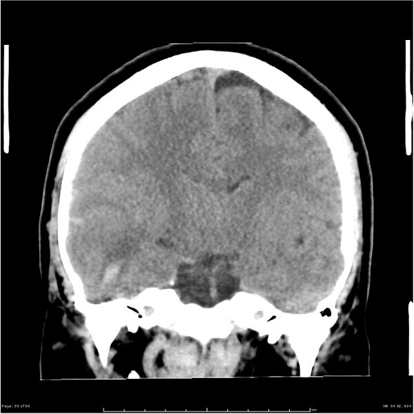 File:Cerebral hemorrhage secondary to arteriovenous malformation (Radiopaedia 33497-34561 Coronal non-contrast 24).jpg