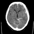 Cerebral hemorrhagic contusions (Radiopaedia 23145-23188 Axial non-contrast 17).jpg