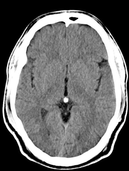File:Cerebral venous angioma (Radiopaedia 69959-79977 Axial non-contrast 16).jpg