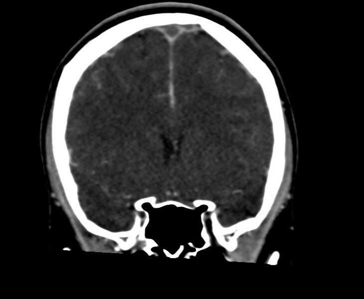 File:Cerebral venous sinus thrombosis (Radiopaedia 59224-66646 Coronal C+ delayed 27).jpg