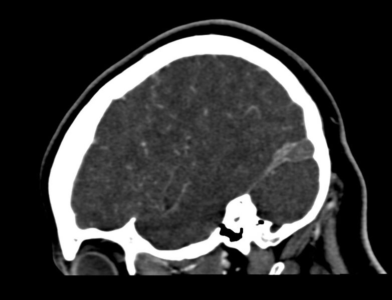File:Cerebral venous sinus thrombosis (Radiopaedia 59224-66646 Sagittal C+ delayed 53).jpg