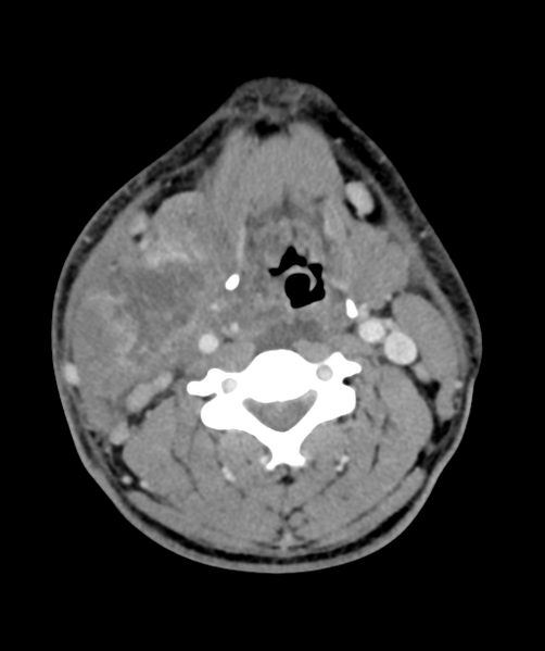 File:Cervical abscess (Radiopaedia 43725-47184 A 35).png