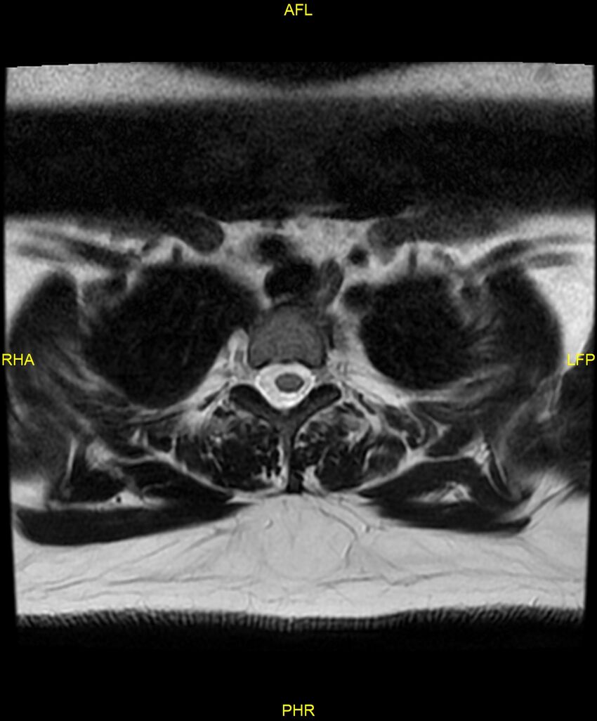 Cervical disc protrusion (Radiopaedia 87147-103415 Axial T2 93).jpg