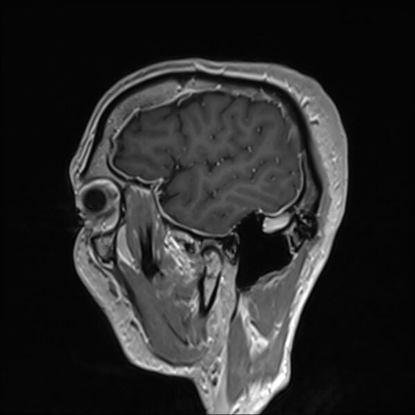 File:Cervical dural CSF leak on MRI and CT treated by blood patch (Radiopaedia 49748-54995 G 5).jpg