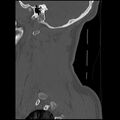Cervical flexion teardrop fracture with cord hemorrhage (Radiopaedia 32497-33454 Sagittal bone window 42).jpg