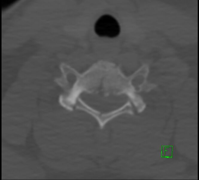 File:Cervical spine fracture - hyperflexion injury (Radiopaedia 66184-75364 Axial bone window 39).jpg