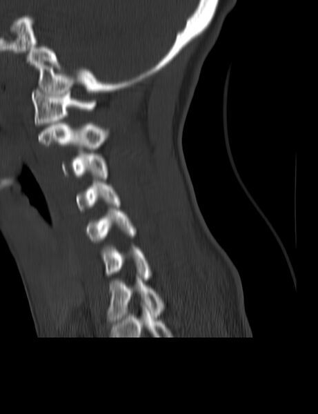 File:Cervical spine posterior ligamentous complex rupture (Radiopaedia 63486-72101 Sagittal bone window 7).jpg