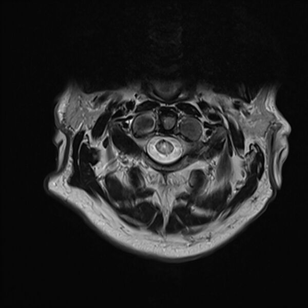 File:Cervical tumor-like myelopathy due to Type V dAVF (Radiopaedia 82461-96604 Axial T2 6).jpg