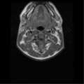 Cervical vertebrae metastasis (Radiopaedia 78814-91667 Axial T1 5).png