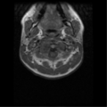 Cervical vertebrae metastasis (Radiopaedia 78814-91667 Axial T1 9).png