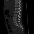 Chance fracture with duodenal and pancreatic lacerations (Radiopaedia 43477-50042 Sagittal bone window 13).jpg