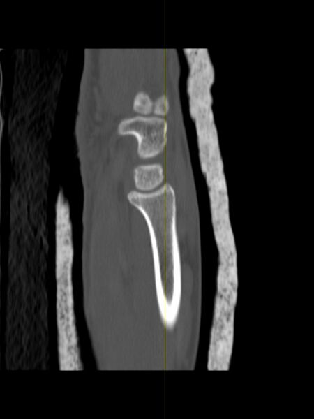 File:Chauffeur's (Hutchinson) fracture (Radiopaedia 58043-65079 Sagittal bone window 5).jpg