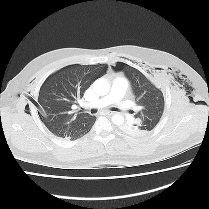 Chest crush injury (Radiopaedia 31620-32513 Axial lung window 25).jpg