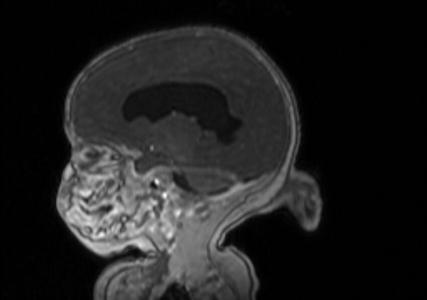 Chiari III malformation with occipital encephalocele (Radiopaedia 79446-92559 Sagittal T1 C+ mpr 42).jpg