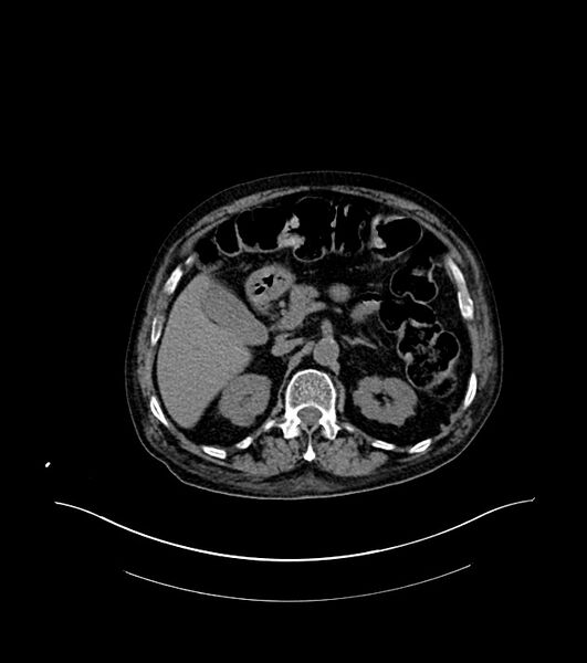 File:Cholangiocarcinoma with cerebral metastases (Radiopaedia 83519-98629 Axial non-contrast 33).jpg