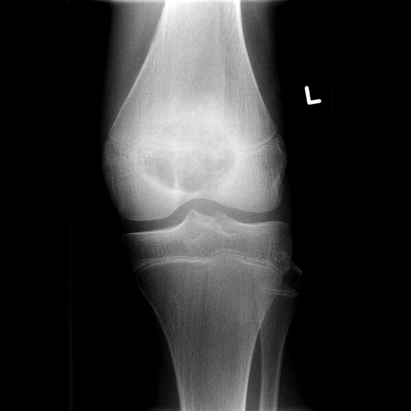 File:Chondroblastoma - distal femur (Radiopaedia 8112-8949 Frontal 1).jpg