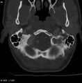Chondroblastoma - occipital condyle (Radiopaedia 5569-7304 bone window 2).jpg