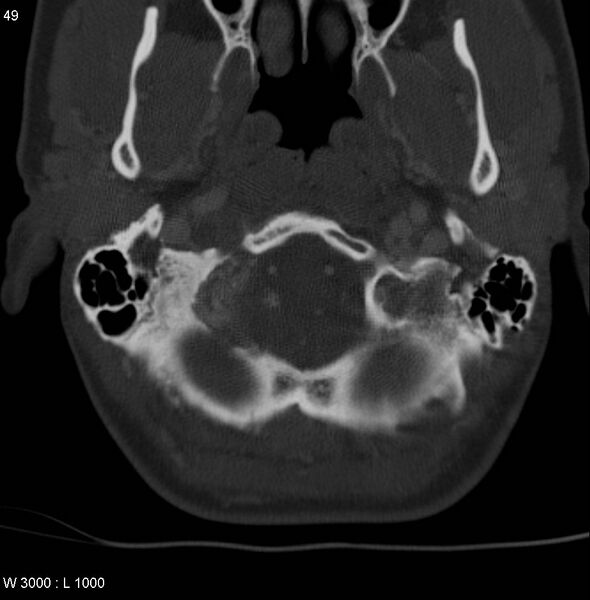 File:Chondroblastoma - occipital condyle (Radiopaedia 5569-7304 bone window 2).jpg
