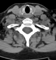 Chordoma (C4 vertebra) (Radiopaedia 47561-52188 Axial non-contrast 40).png