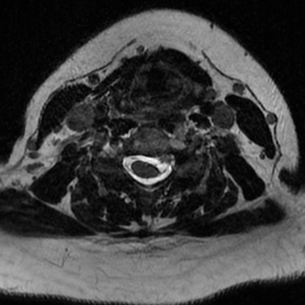 File:Chordoma - cervical spine (Radiopaedia 70084-80111 Axial T2 54).png