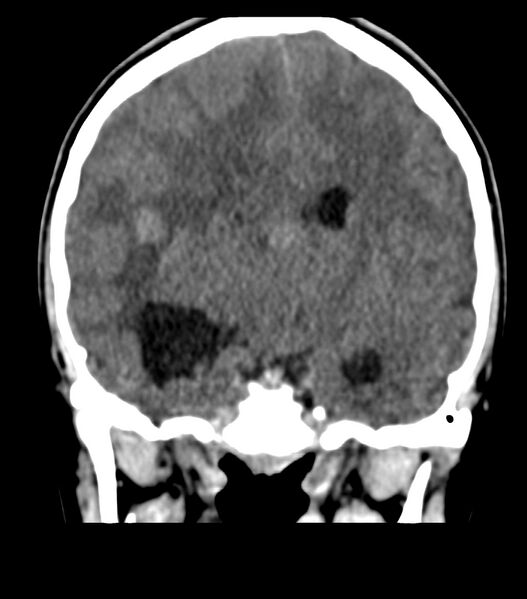 File:Choroid plexus carcinoma (Radiopaedia 91013-108552 Coronal non-contrast 42).jpg