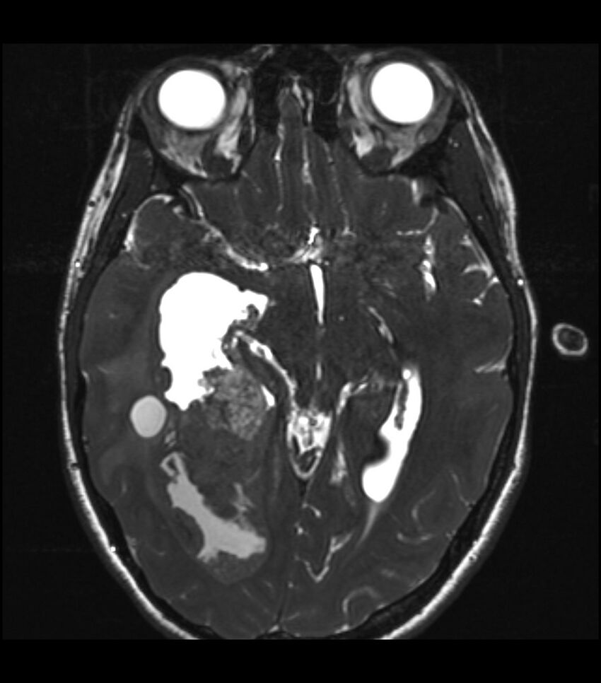 Choroid plexus carcinoma (Radiopaedia 91013-108553 Axial T2 CISS 25).jpg