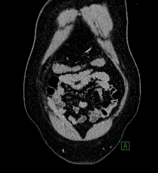 File:Chromophobe renal cell carcinoma (Radiopaedia 84286-99573 H 25).jpg
