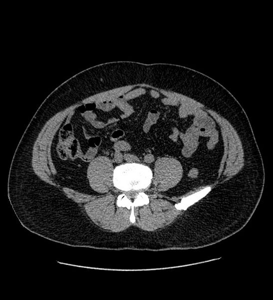 File:Chromophobe renal cell carcinoma (Radiopaedia 84337-99693 Axial non-contrast 99).jpg