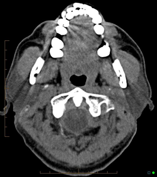 File:Chronic Submandibular sialolithiasis (Radiopaedia 16880-16606 Axial non-contrast 5).jpg