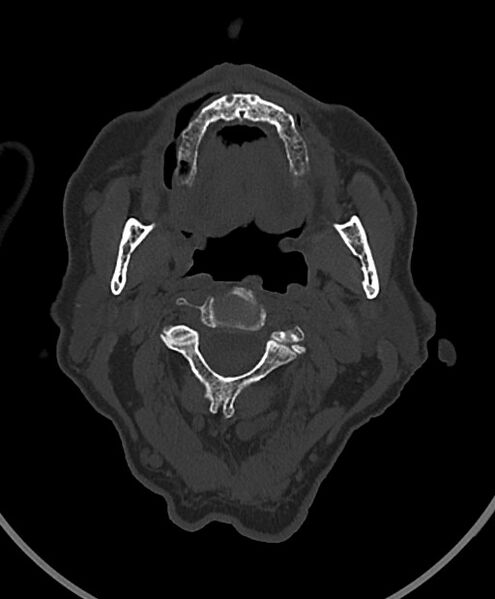 File:Chronic bilateral subdural hygroma (Radiopaedia 85801-101623 Axial bone window 128).jpg