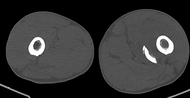 File:Chronic osteomyelitis (with sequestrum) (Radiopaedia 74813-85822 Axial non-contrast 78).jpg