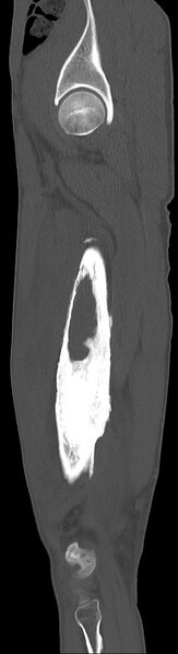 File:Chronic osteomyelitis (with sequestrum) (Radiopaedia 74813-85822 C 84).jpg