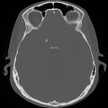 Chronic otomastoiditis (Radiopaedia 27138-27309 Axial bone window 55).jpg