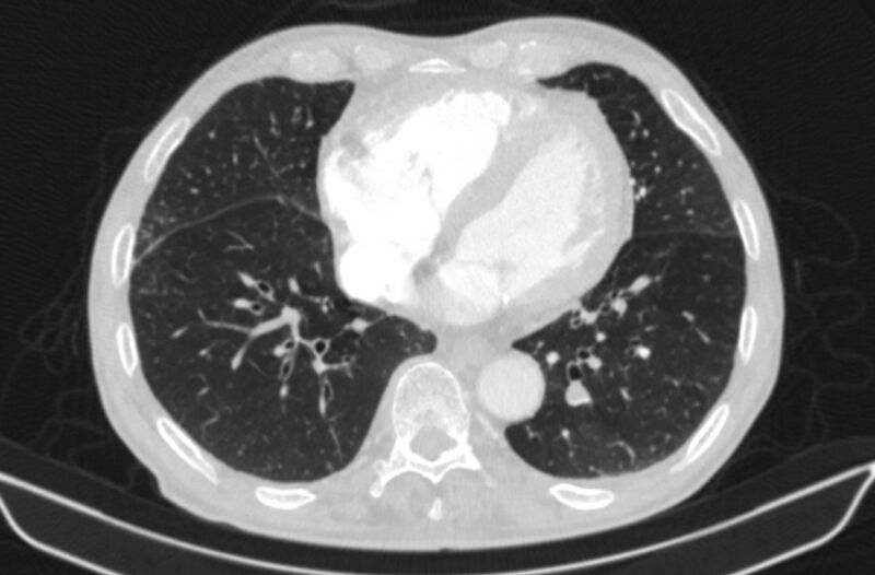 File:Chronic pulmonary embolism (Radiopaedia 91241-108843 Axial lung window 64).jpg