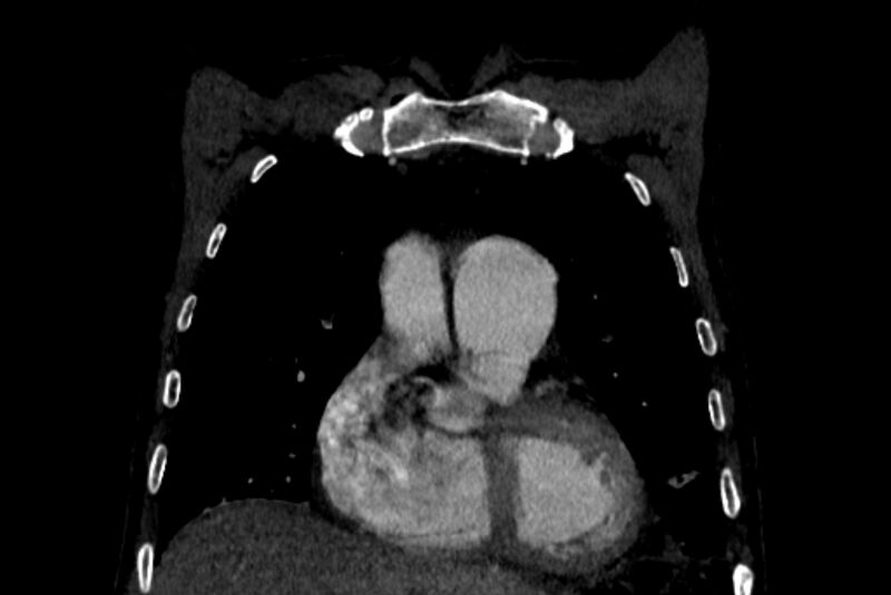File:Chronic pulmonary embolism with bubbly consolidation (Radiopaedia 91248-108850 B 38).jpg