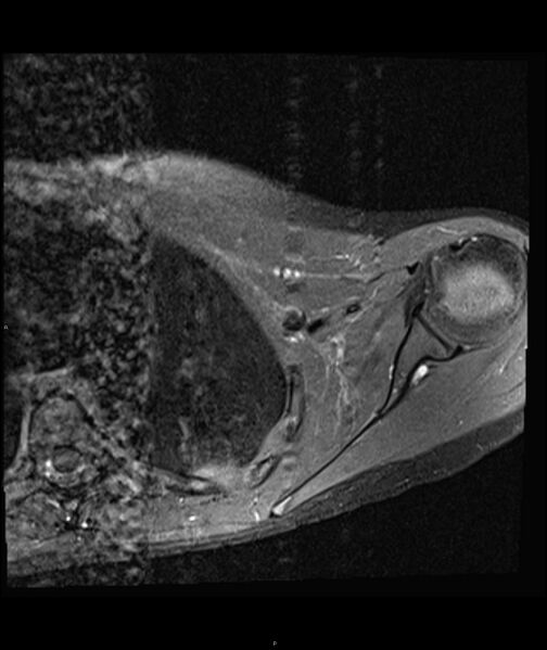 File:Chronic reactive multifocal osteomyelitis (CRMO) - clavicle (Radiopaedia 56406-63071 Axial T1 C+ fat sat 17).jpg