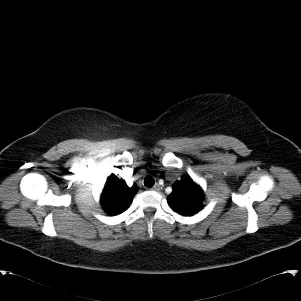 File:Chronic thromboembolic pulmonary hypertension (CTEPH) (Radiopaedia 74597-85531 Axial C+ CTPA 8).jpg
