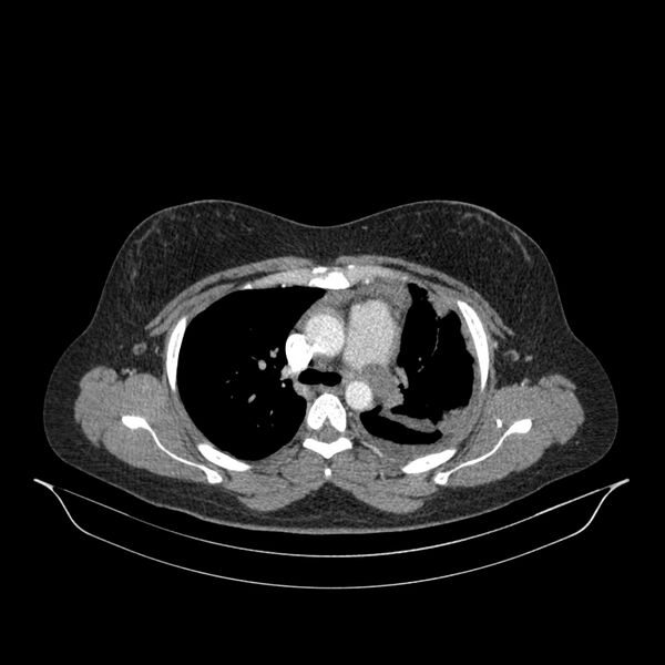File:Chronic thromboembolic pulmonary hypertension (CTEPH) (Radiopaedia 74597-85532 Axial C+ CTPA 106).jpg