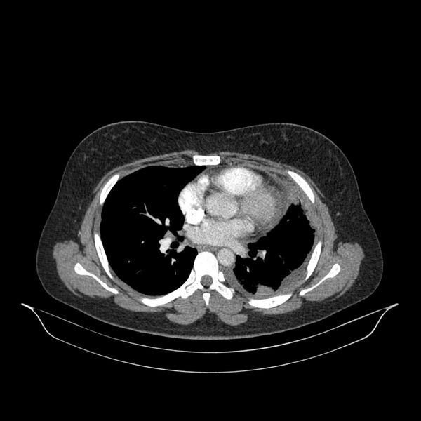 File:Chronic thromboembolic pulmonary hypertension (CTEPH) (Radiopaedia 74597-85532 Axial C+ CTPA 81).jpg